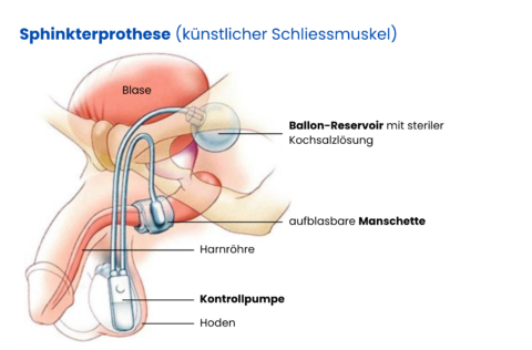 Illustration einer Sphinkterprothese