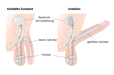 Example graphic of a penile prosthesis
