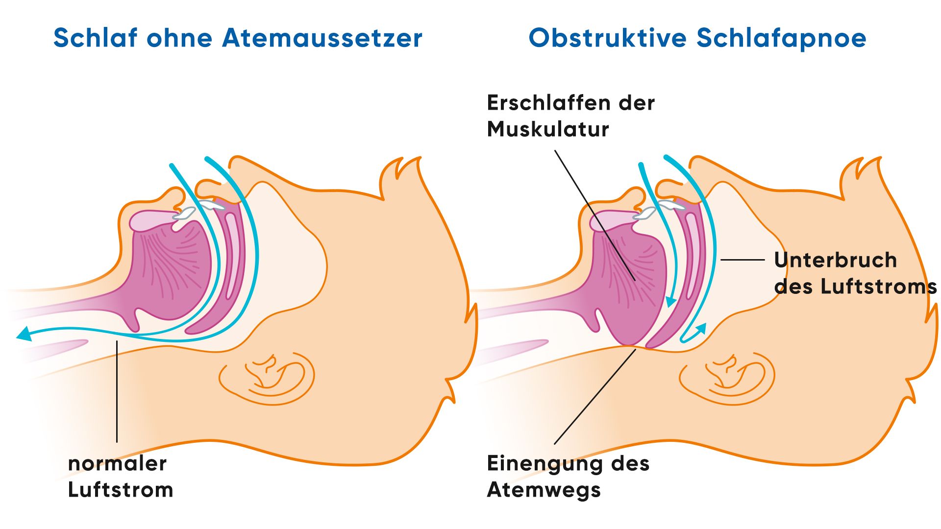 Illustration Schlaf ohne Atemaussetzer und mit obstruktiver Schlafapnoe