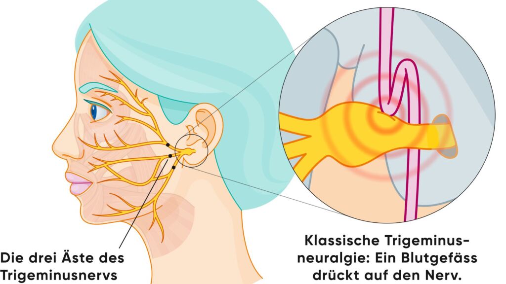Illustration Trigeminusnerven und Blutgefässe