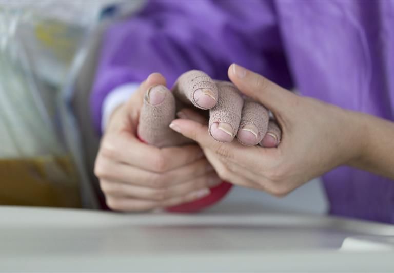 Eine verbrannte Hand, die gepflegt wird