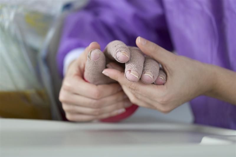 Eine verbrannte Hand, die gepflegt wird
