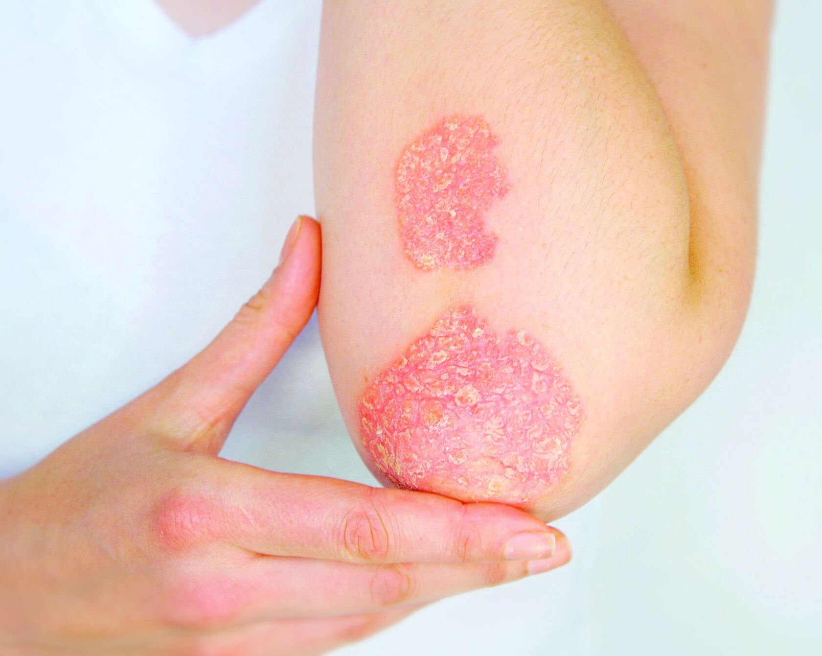 Psoriasis