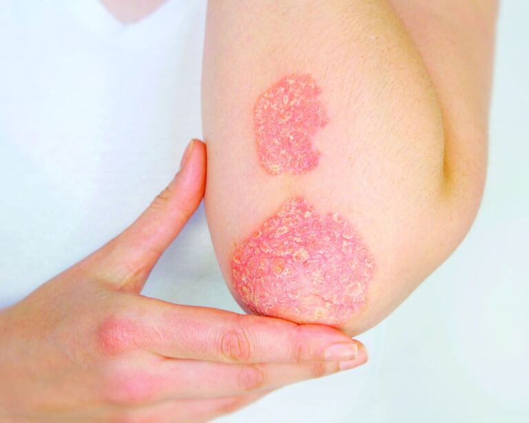 Psoriasis
