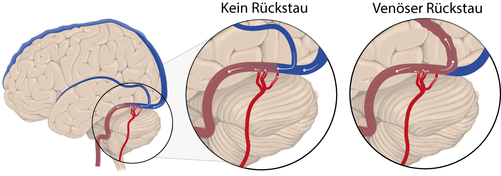 Durale Arteriovenöse Fistel
