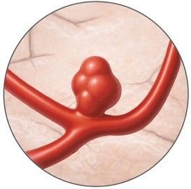 Nicht rupturiertes Hirnaneurysma