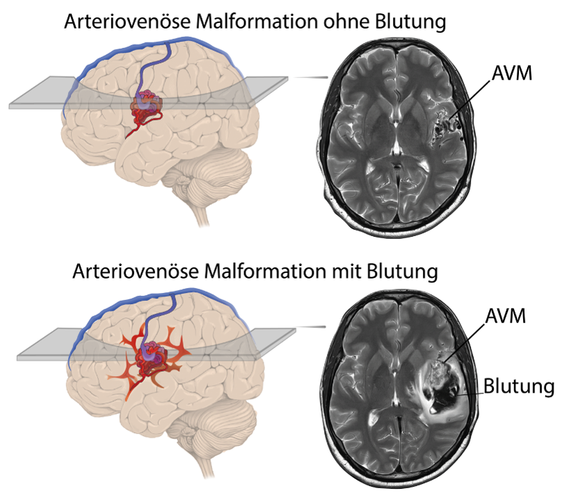 Arteriovenöse Malformation.