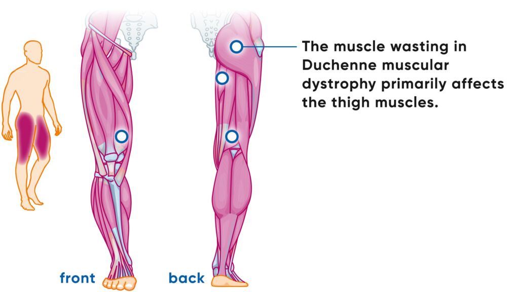 Illustration Duchenne Muskeldystrophie