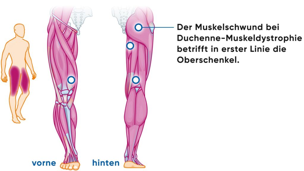 Illustration Duchenne Muskeldystrophie