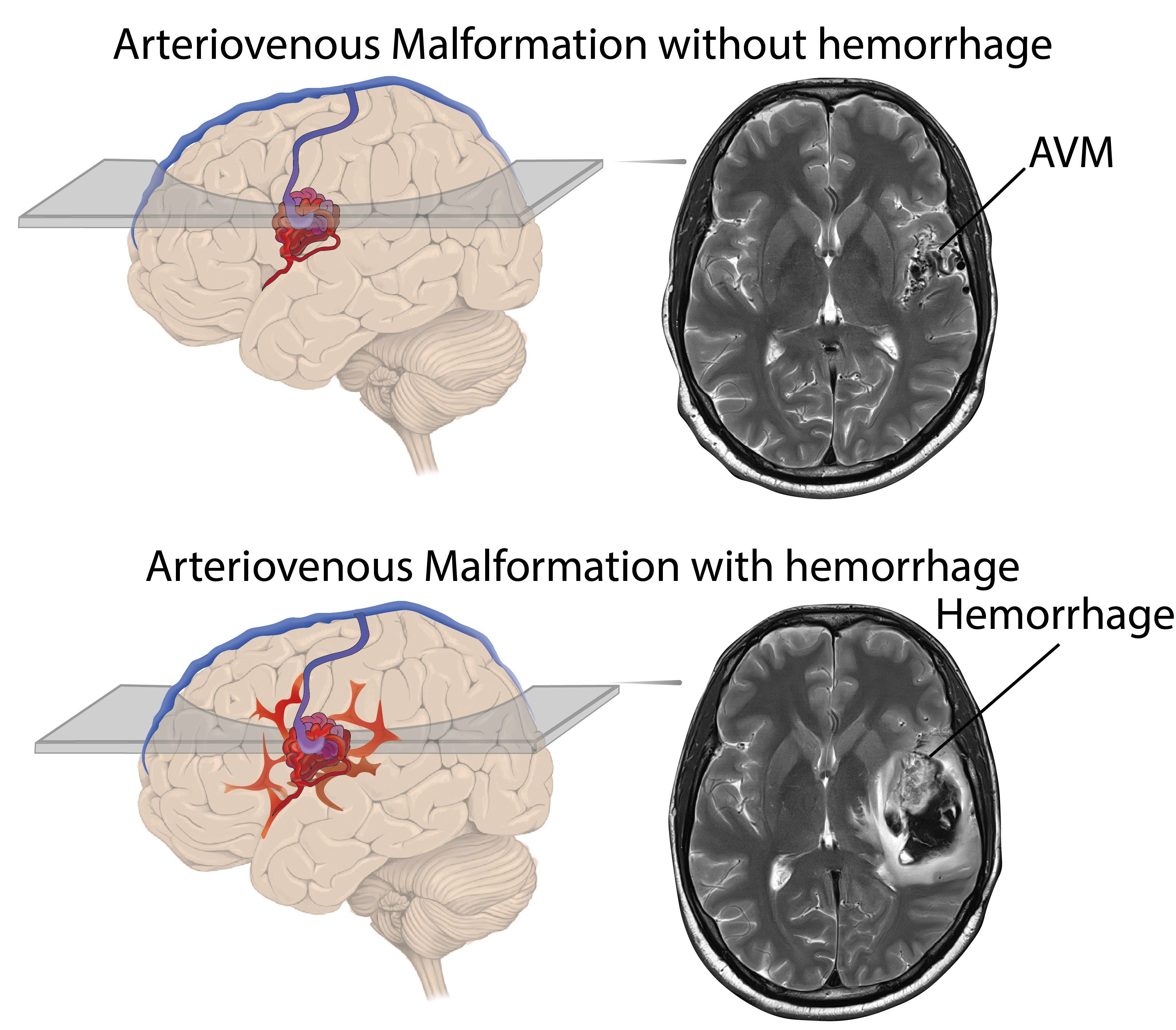 Arteriovenöse Malformation.
