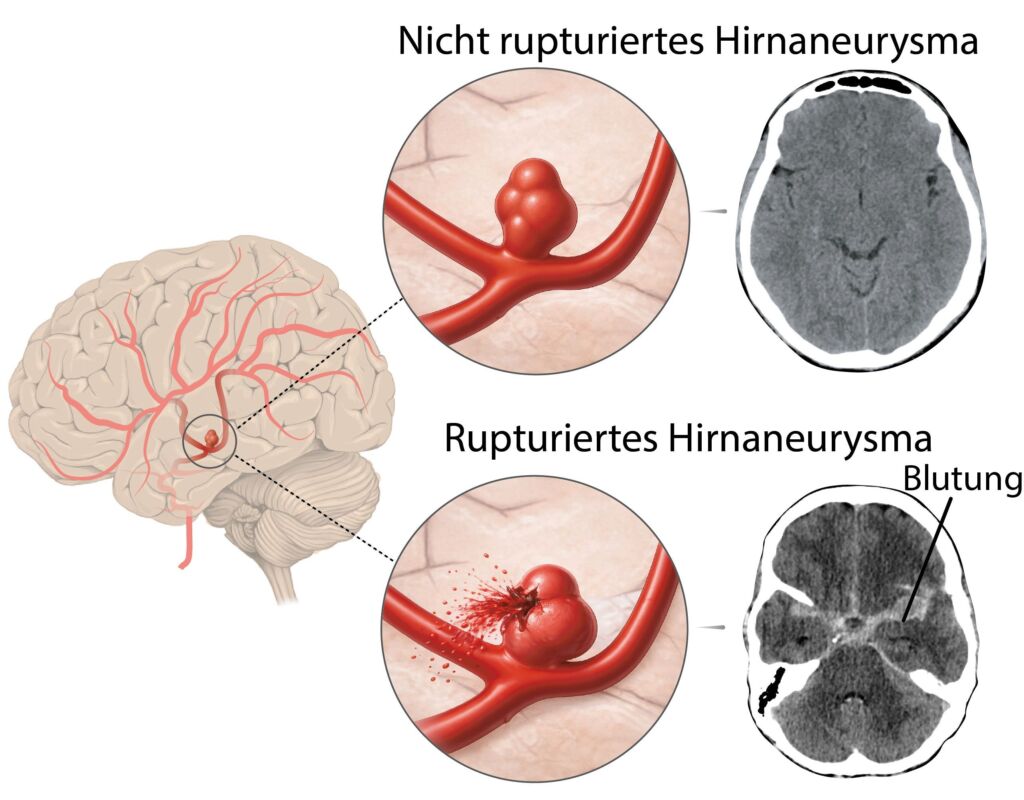 Illustration rupturiertes und nicht rupturiertes Hirnaneurysma
