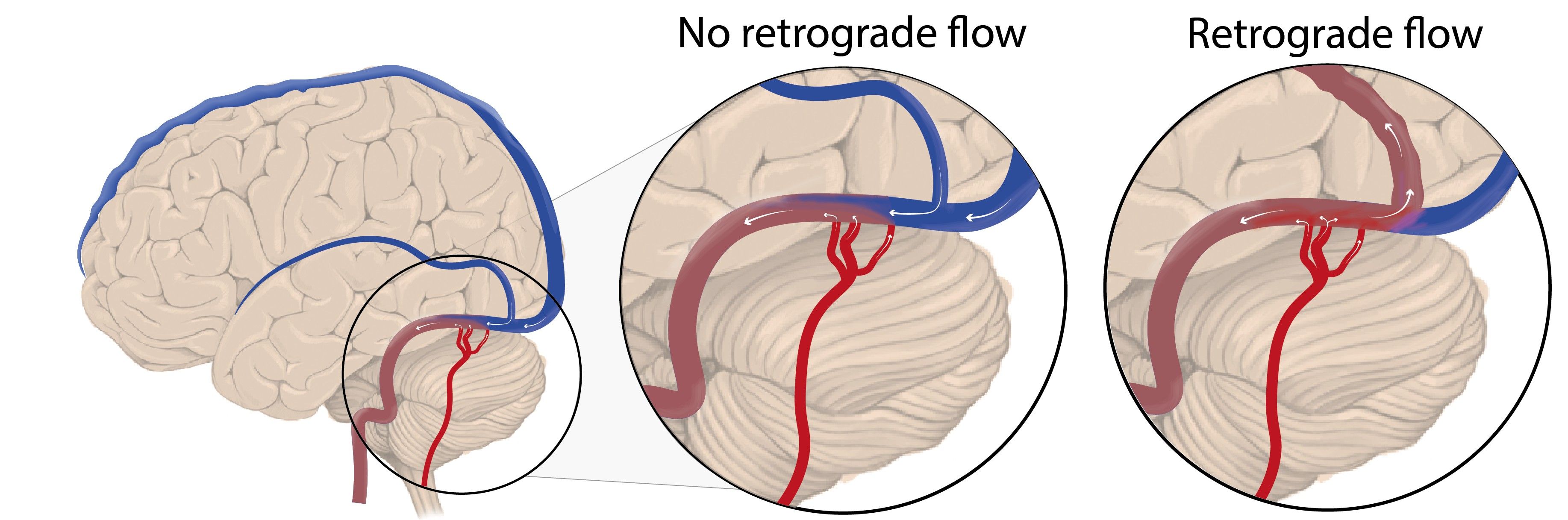 Durale Arteriovenöse Fistel